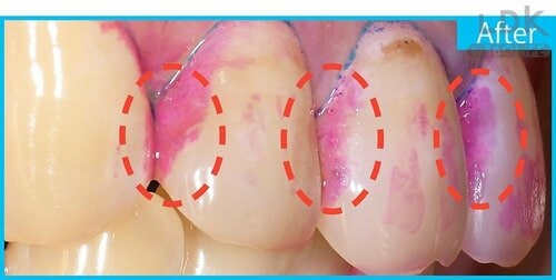 After:歯と歯の間に汚れが残った LDKベストバイ大人用電動歯ブラシおすすめ イメージ