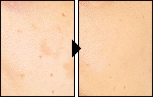 コンシーラーを塗ってシミを隠した様子