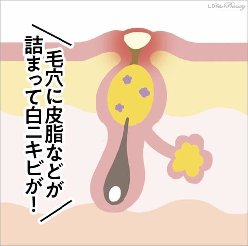 白ニキビ段階でのケアが明暗を分ける! ニキビケア洗顔料おすすめ イメージ
