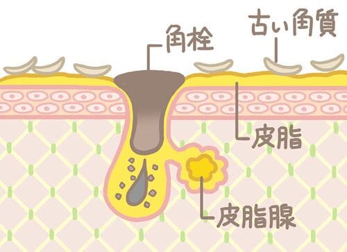 詰まり毛穴・黒ずみ毛穴：過剰な皮脂分泌で毛穴が詰まりやすくなる ビタミンC美容液おすすめ イメージ