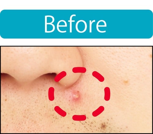 【ニキビ隠し】赤ニキビをキレイに隠せた メンズコンシーラーおすすめ イメージ