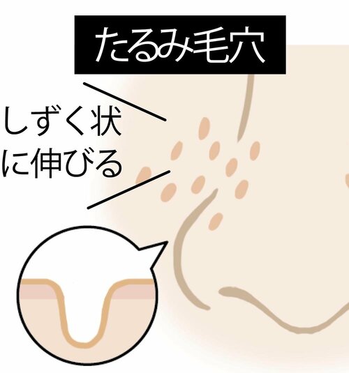 毛穴目立ちの原因や毛穴タイプの例 イメージ4