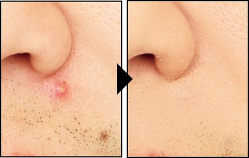 コンシーラーでニキビを隠した様子