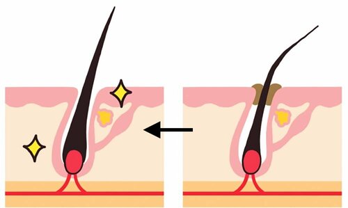 薄毛対策に効果アリ？ 頭皮クレンジングで「毛穴詰まり」を解消すべき理由 メンズ頭皮クレンジングおすすめ イメージ