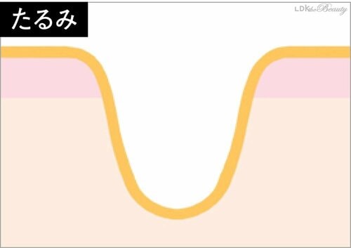 【たるみ】頬を中心に縦長に広がっている 美容の裏ワザおすすめ イメージ
