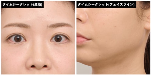 “人中短縮”には不向きかも シェーディングおすすめ イメージ