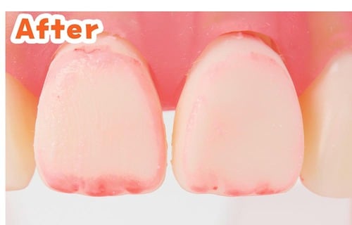 人工歯垢の汚れ落ち:After 歯磨き粉おすすめ イメージ
