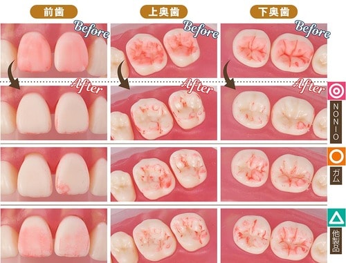 汚れ落ち：丁寧に磨けば問題なく汚れが落ちた 歯ブラシおすすめ イメージ