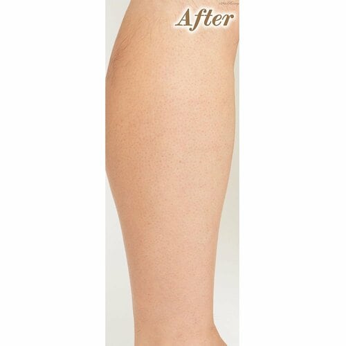 After(1カ月後) 2024年ベストコスメおすすめ イメージ