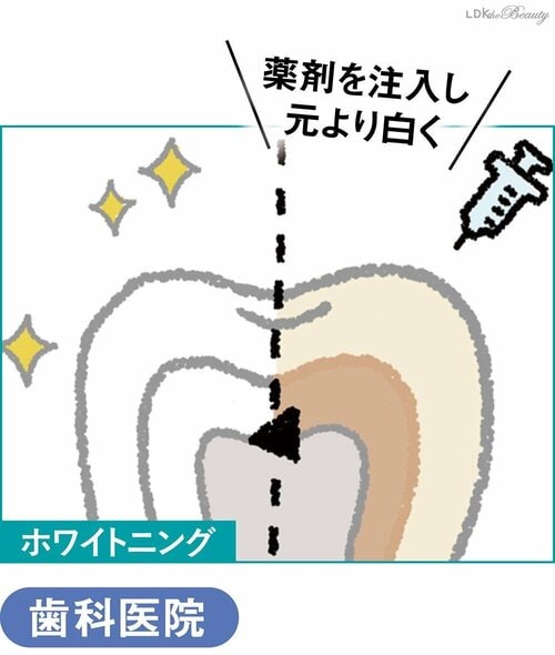 歯の美白、ホームケアには限界がある? ホワイトニング歯磨き粉おすすめ イメージ2