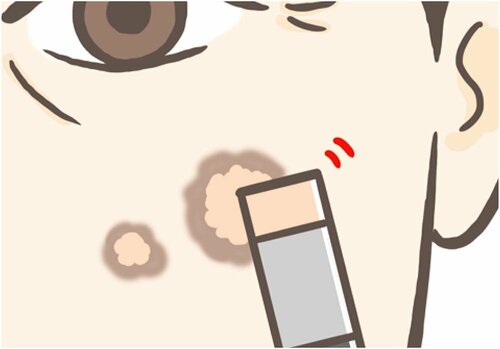 1:シミ・ニキビへ乗せるように塗る メンズコンシーラーおすすめ イメージ