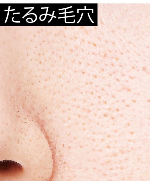 おすすめ:たるみ毛穴はレチノールで肌をふっくらさせる イメージ