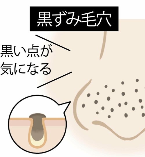毛穴目立ちの原因や毛穴タイプの例 イメージ2