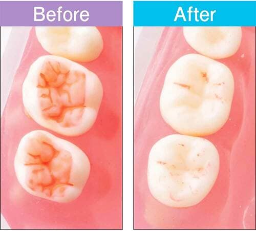 汚れ落ち：前歯も奥歯もつるっつる！未体験の気持ち良さ 歯ブラシおすすめ イメージ