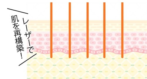 フラクショナルCO2レーザーとは? イメージ