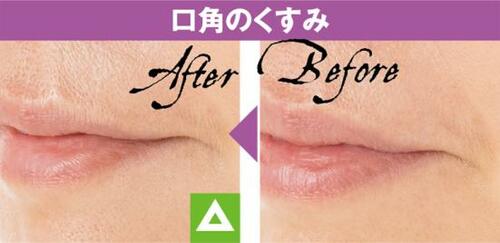 4位: コンシーラーというよりハイライト使いがおすすめ コンシーラーおすすめ イメージ4