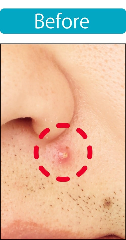 【ニキビ隠し】1回では隠れないが、重ね使いで隠せた メンズコンシーラーおすすめ イメージ