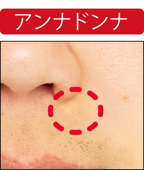 【ニキビ隠し】赤ニキビをキレイに隠せた メンズコンシーラーおすすめ イメージ2