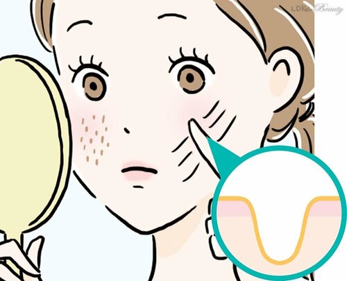 【たるみ毛穴】頬を中心に形が縦長に崩れている SNSでバズった毛穴ケアおすすめ イメージ