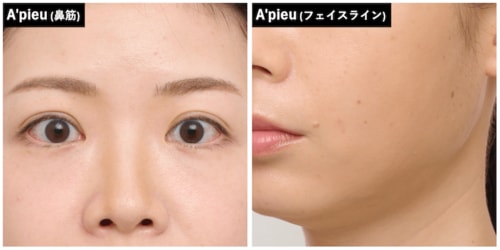 赤みが目立ってしまった シェーディングおすすめ イメージ