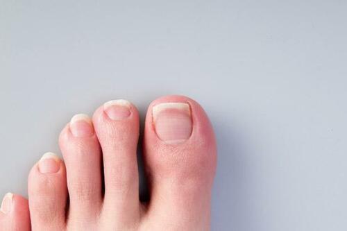 正しい爪の切り方(2):足の親指は角を残して巻き爪回避!