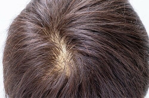 薄毛が気になる頭頂部
