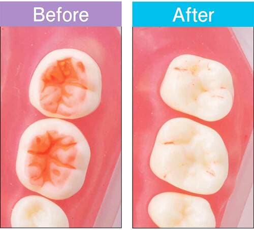 汚れ落ち：前歯も奥歯もつるっつる！未体験の気持ち良さ 歯ブラシおすすめ イメージ2