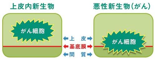 Q2:上皮内新生物も保障するがん保険の方がいいの?