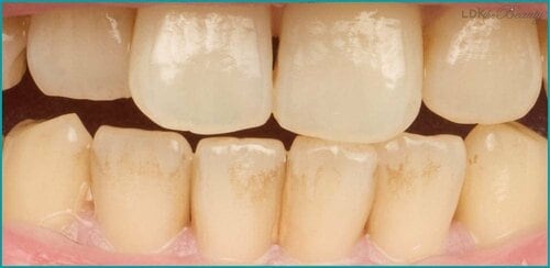 軽い着色汚れ落としなら効果的 ホワイトニング歯磨き粉おすすめ イメージ