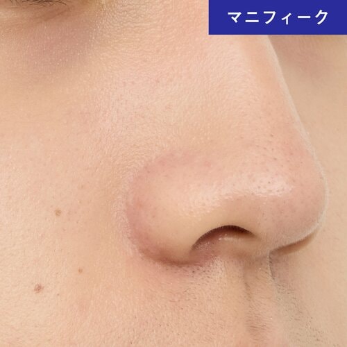 赤みやニキビ跡が隠しきれない メンズBBクリームおすすめ イメージ