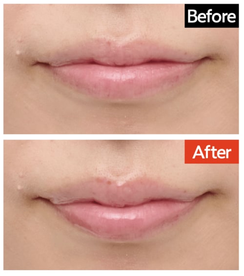 仕上がり：縦にボリュームアップしうるうる感もプラスした リッププランパーおすすめ イメージ