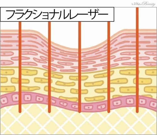 ニキビ跡はレーザーじゃないと消えない？ ニキビケア化粧水おすすめ イメージ