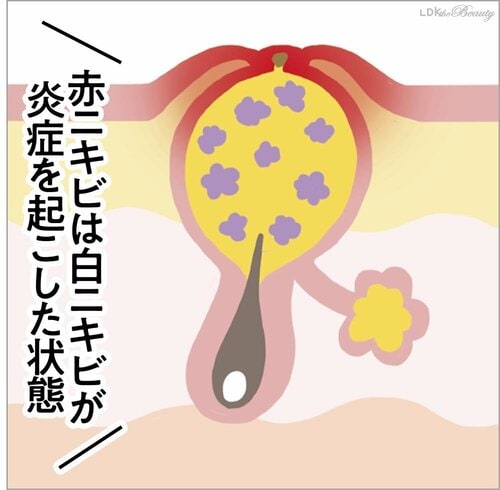 白ニキビ段階でのケアが明暗を分ける! ニキビケア洗顔料おすすめ イメージ2