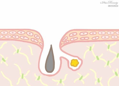 開き毛穴・たるみ毛穴：ハリが不足し毛穴が開いてたるむ ビタミンC美容液おすすめ イメージ