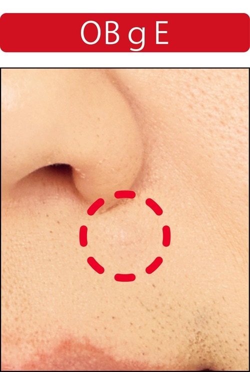 【ニキビ隠し】1回では隠れないが、重ね使いで隠せた メンズコンシーラーおすすめ イメージ2