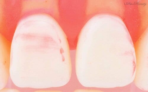 汚れ落ち オーラルケアアイテムおすすめ イメージ2