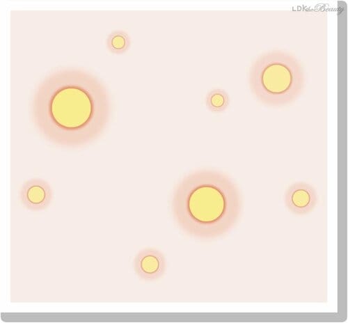 ニキビをつぶすのはよくない？ ニキビケア化粧水おすすめ イメージ