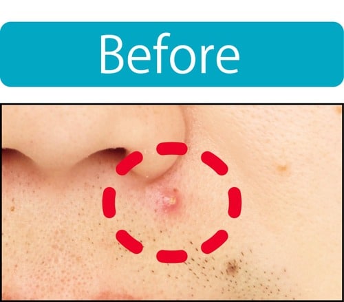 【ニキビ隠し】ニキビの赤みは抑えられた メンズコンシーラーおすすめ イメージ