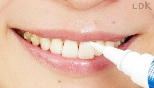 感動ポイント:ペンタイプだから細部まで塗りやすい LDKベストバイ歯の美白アイテムおすすめ イメージ
