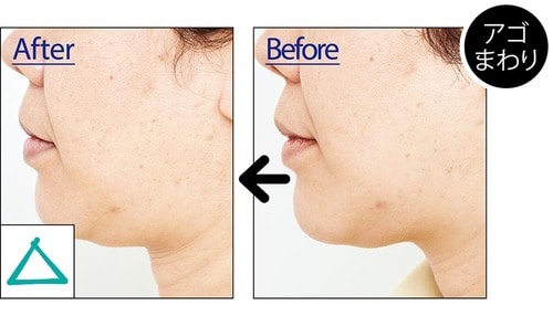 リフトアップは短期間ではあまり実感できない イメージ