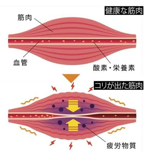 低周波治療器は電気の力で筋肉を動かして滞った血流を改善する
