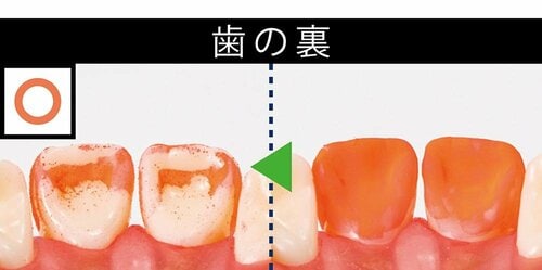 ポイント1:奥歯や歯間の歯垢をやわらか毛先でキャッチ! イメージ