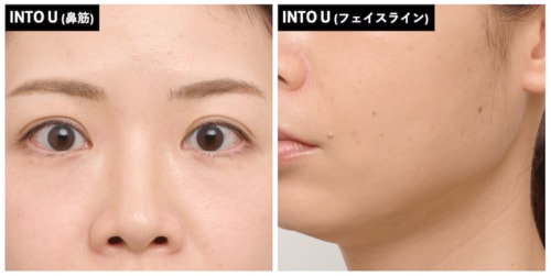 フケ顔に見えやすい シェーディングおすすめ イメージ