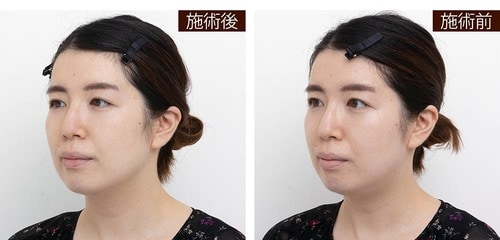 ヘッドスパのみでフェイスラインがスッキリした イメージ