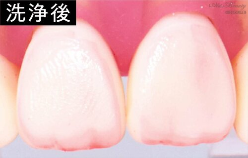 汚れ落ち：まんべんなく落とした ホワイトニング歯磨き粉おすすめ イメージ