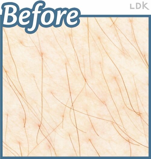 Before VIOシェーバーおすすめ イメージ