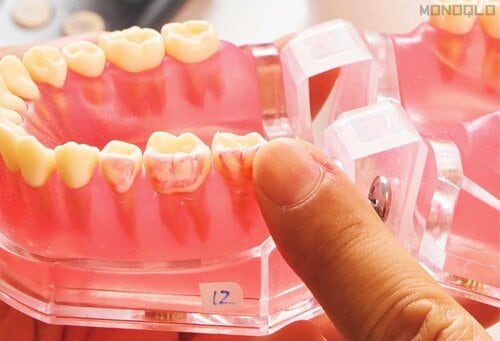 テスト3:汚れ落ち 歯磨き粉おすすめ イメージ