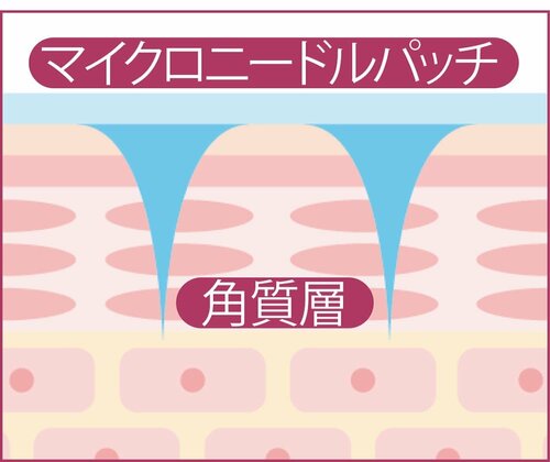 貼るとき細かい針がちょっと痛いけど、即効性は期待できる! イメージ