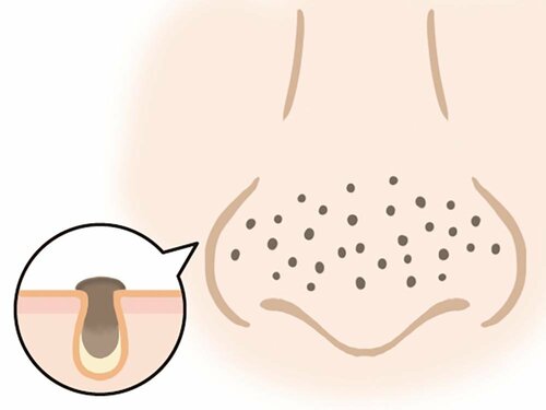 黒ずみ毛穴 毛穴クレンジングおすすめ イメージ