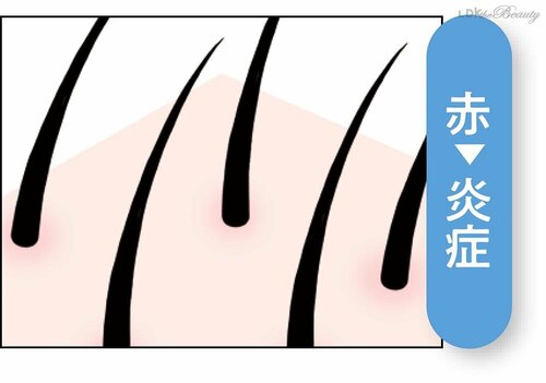 頭皮の色が髪の健康バロメーター イメージ4